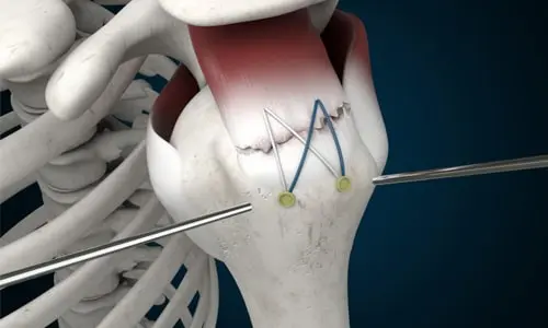 Rotator Manşet Yırtığı Nedenleri, Belirtileri ve Ameliyatı