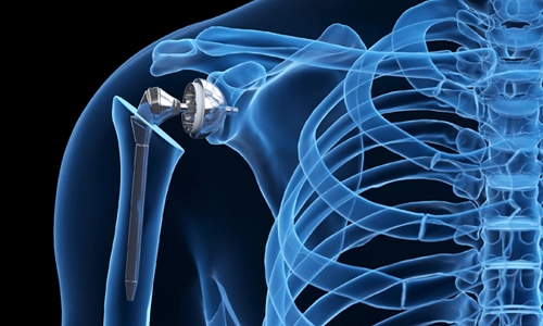 Omuz Protezi Ameliyatı Nedir? Çeşitleri? Öncesi ve Sonrası
