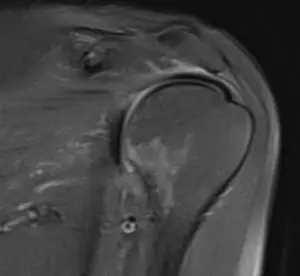 Omuz sıkışma sendromu tanısı olan hastanın MR görüntüsü.