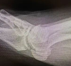 Orta derecede başparmak kireçlenmesi yan (lateral) X Ray görüntüsü