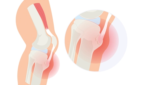 Osgood Schlatter Hastalığı Nedir? Neden Olur? Tedavisi?