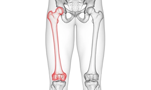 Osteoid Osteoma Nedir? Belirtileri ve Tedavisi