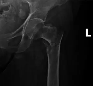 Osteoporoz (Kemik Erimesi) Bağlı Kalça Kırığı Röntgen Görüntüsü