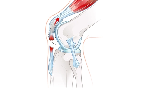 Patellar Tendon Rüptürü Nedir? Tedavisi ve Ameliyatı