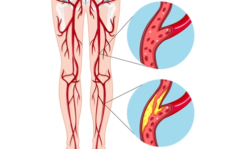 Periferik Arter Hastalığı Nedir? Belirtileri? Tedavisi?