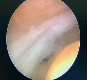 Plika sendromu diz artroskopisi ile tedavi edilirken çekilmiş plika görüntüsü.