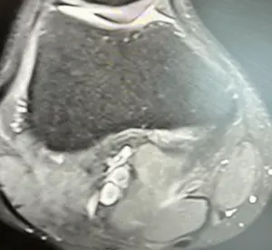 Plika sendromu MR görüntüsü.
