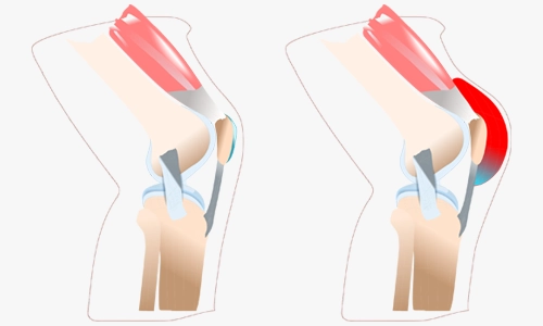 Prepatellar Bursit Nedir? Nedenleri, Belirtileri ve Tedavisi