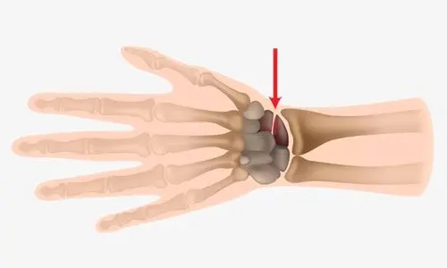 Skafoid Kırığı Ameliyatı