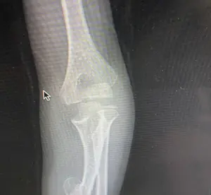 Sol ulna alt uçta izlenen osteokondrom ve buna bağlı ulna kemiğinde izlenen eğrilik ve kısalık.