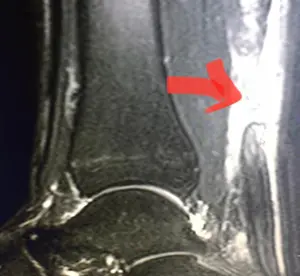 T1 MR görüntülemesinde, Aşil tendon kopması ve aşil tendonunda devamsızlık ve boşluk (gap).