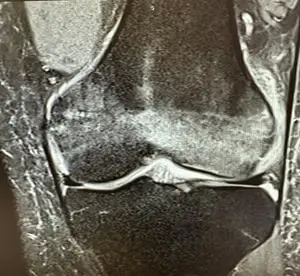 T2 koronal DİZ MR kesitinde femur lateral kondilde stres kırığı.