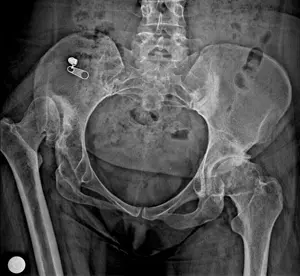 Tedavi edilmemiş bir doğuştan kalça çıkığı hastasının röntgen görüntüsü görülmektedir.