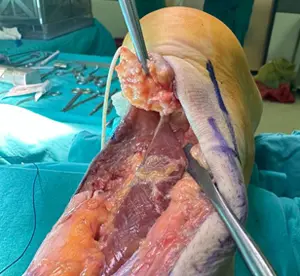 Tedavisiz kalmış, kronik aşil tendon kopmasında yapılan Tendon transferi (FHL tendon transferi) ameliyatı.
