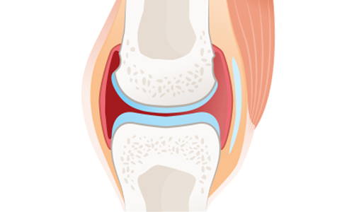 Artrofibrozis Nedir? Belirtileri ve Ameliyatı