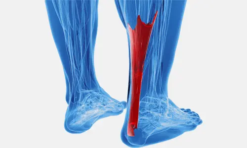 Aşil Tendon Ameliyatı