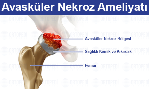 Avasküler Nekroz Ameliyatı Nedir? Belirtileri ve Tedavisi