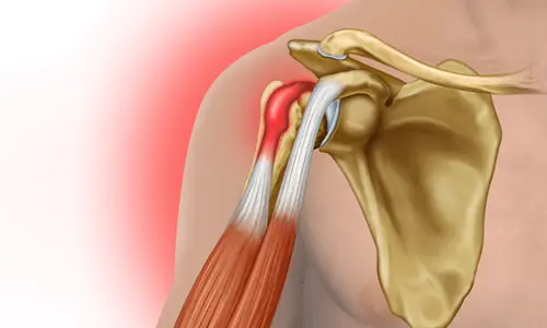 Biceps Tendiniti