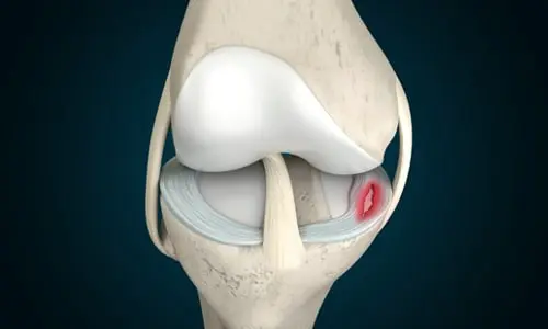 Diskoid Menisküs Nedir? Tanısı ve Tedavisi