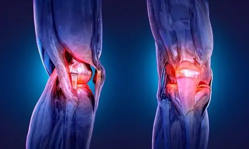 Diz Artroplasti Revizyonu Nedir? Nasıl Yapılır?