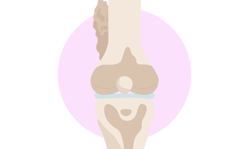 Ewing Sarkomu (Sarcoma) Belirtileri ve Tedavisi