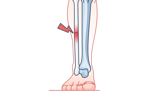 Fibula (Baldır) Kemiği Kırığı Nedir? Belirtileri ve Tedavisi