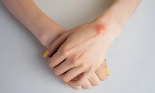Ganglion Kisti Nedir? Neden Olur? Tanı ve Tedavisi