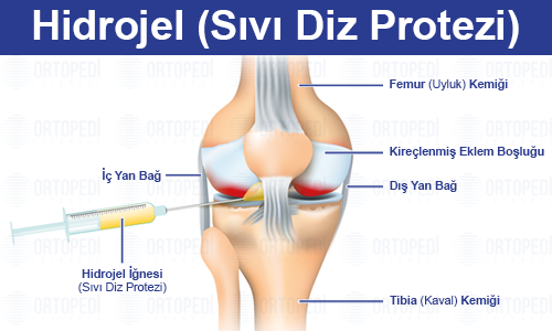Sıvı Diz Protezi (Hidrojel) Nedir? Kalıcı Mı? Nasıl Yapılır?
