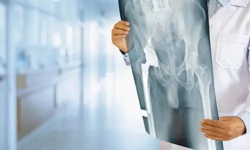 Kalça Çıkığında Eklem Replasmanı Nedir? Kaç Yaşında Yapılmalı?
