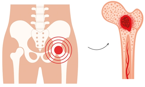 Kemik İltihabı (Osteomiyelit) Nedir? Belirtileri? Tedavisi?