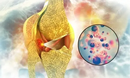 Bone Tumor Treatment & Surgery