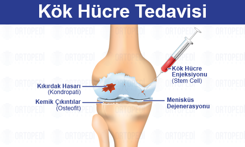 Kök Hücre Tedavisi Nedir? Nasıl Yapılır?