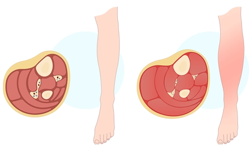 Kompartman Sendromu Nedir? Belirtileri, Tanısı ve Tedavisi