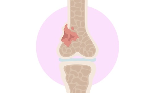 Kondrosarkom (Chondrosarcoma) Belirtileri ve Tedavisi