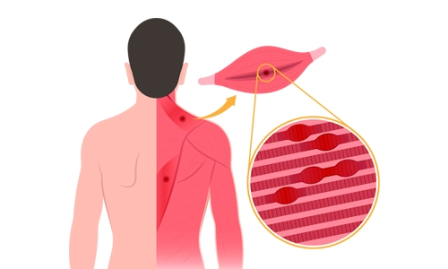 Kulunç (Miyofasyal Ağrı Sendromu) Nedir? Tipleri ve Tedavisi