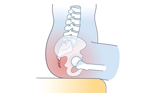 Kuyruk Sokumu Ağrısı (Koksidini) Nedir? Tanı ve Tedavisi