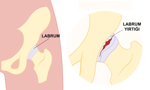 Labrum Yırtığı Nedir? Labrum Yırtığı Tedavisi ve Ameliyatı