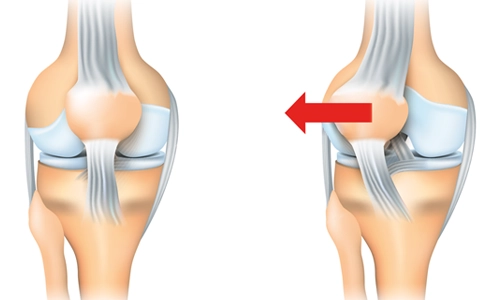 Lateral Patellar Gevşetme Ameliyatı Nedir? Ne Zaman Yapılır?