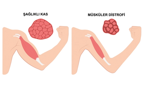 Müsküler Distrofi Nedir? Müsküler Distrofi Tedavisi?