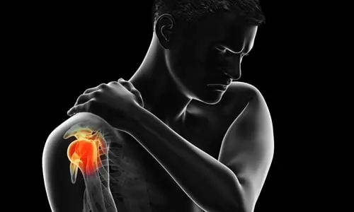 Omuz Sıkışma Sendromu Nedir? Belirtileri ve Ameliyatı