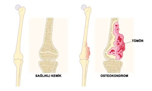 Osteokondrom