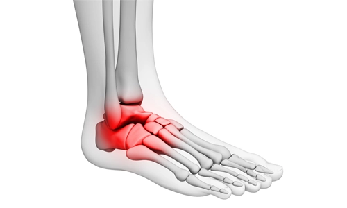 Osteokondrom Nedir? Belirtileri ve Tedavisi