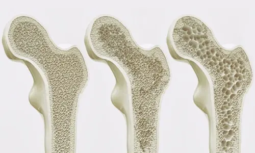 Osteoporoz (Kemik Erimesi) Bağlı Kalça Kırığı