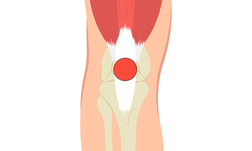 Patella Kırığı Nedir? Tanısı, Tedavisi ve Ameliyatı