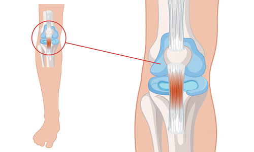 Patellar Tendinit Nedir? Neden Olur? Sebebi Nedir?