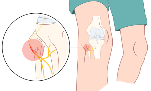 Peroneal Sinir Hasarı Nedir? Tanısı ve Tedavisi
