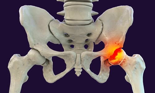 Perthes Hastalığı Nedir? Belirtileri ve Tedavisi