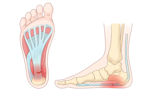 Plantar Fasiit Nedir? Belirtileri, Tanısı ve Tedavisi