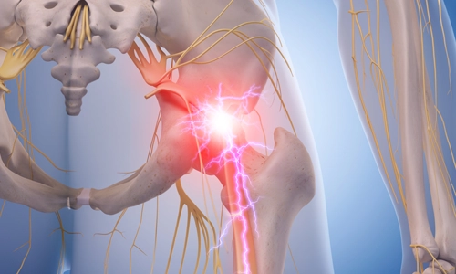 Posterior Femoral Kutanöz Sinir Tuzaklanması Tanı ve Tedavi