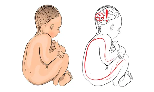 Serebral Palsi Nedir? Tedavisi ve Ameliyatı
